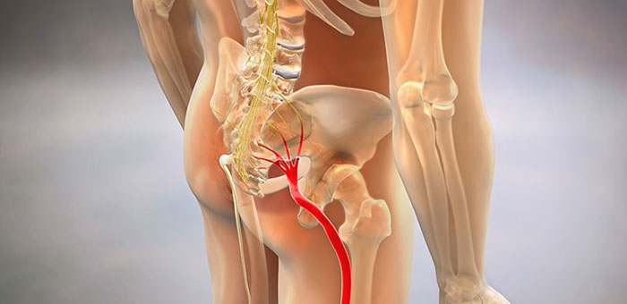 Sciatic nerve pain before chiropractic treatment from Cleveland chiropractor