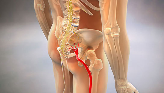 Sciatic nerve pain before chiropractic treatment from Cleveland chiropractor